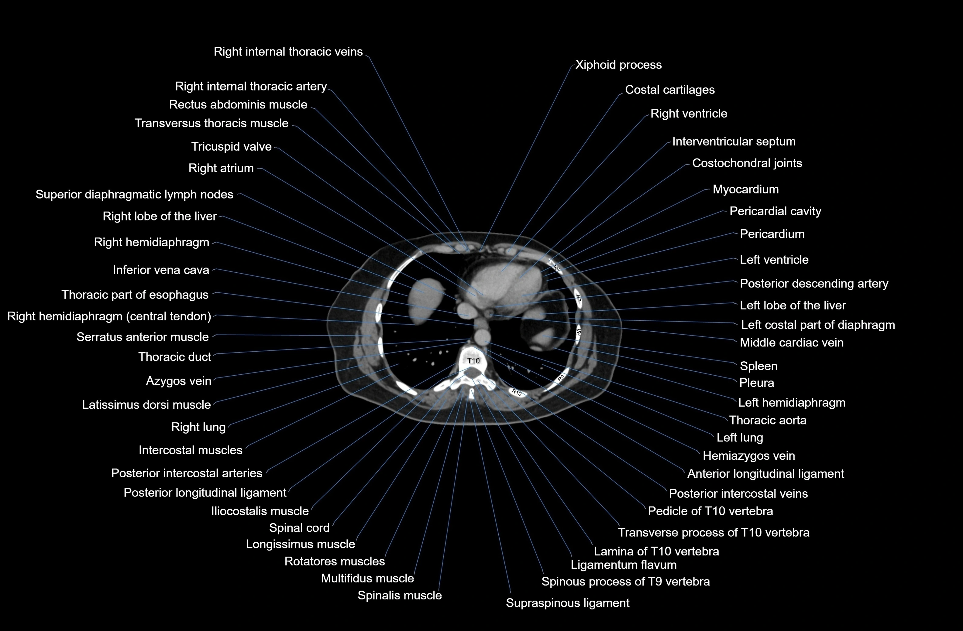 CT Abdomen axial cross sectional anatomy labelled radiology image-00006.webp